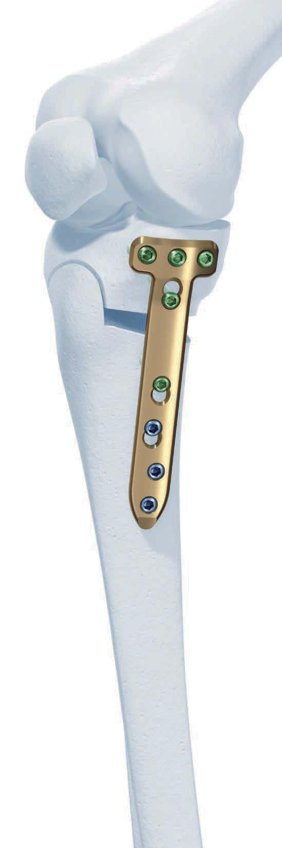 TomoFix Osteotomy System. A comprehensive plating system for stable fixation of osteotomies around the knee.