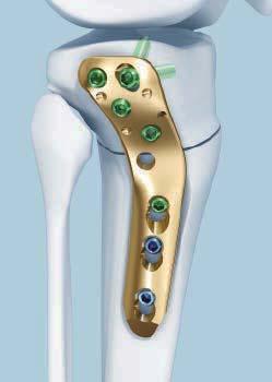 Spacers reduce plate-to-bone contact.