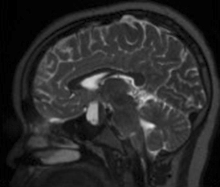 2 Child 4 Coronal unenhanced T1 MRI showing a tumour splaying the optic chiasm Fig.