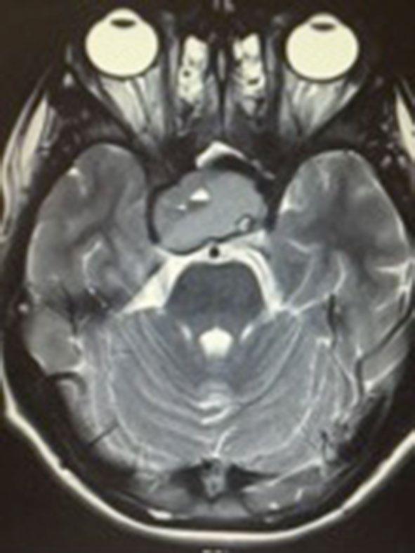 There is evidence of central necrotic change and blood-fluid levels Fig. 3 Child 4 Sagittal T2 weighted imaging shows a fluid/blood level in keeping with haemorrhage struggling at school.