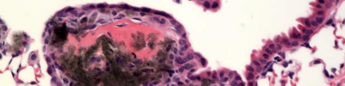 adjacent alveoli o Hypocellular