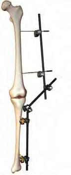 length to cross proximal end of tibial bar Connector bars Attach Quick or Freedom Bar to Bar Clamps to the tibial and femoral bars Attach a third bar into