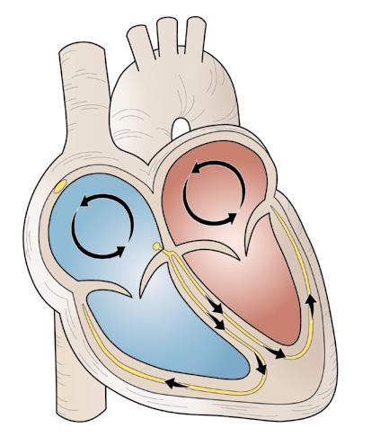 Atrial flutter: Impulses that go from the atria to the ventricles have too many unorganized signals.