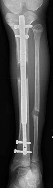 Case studies: 11 year old female tibial