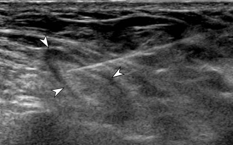 Prior to MR image acquisition, the patient was positioned in a supine fashion on a MR-feasible table, which was placed in an ultrasound room outside the MR room.