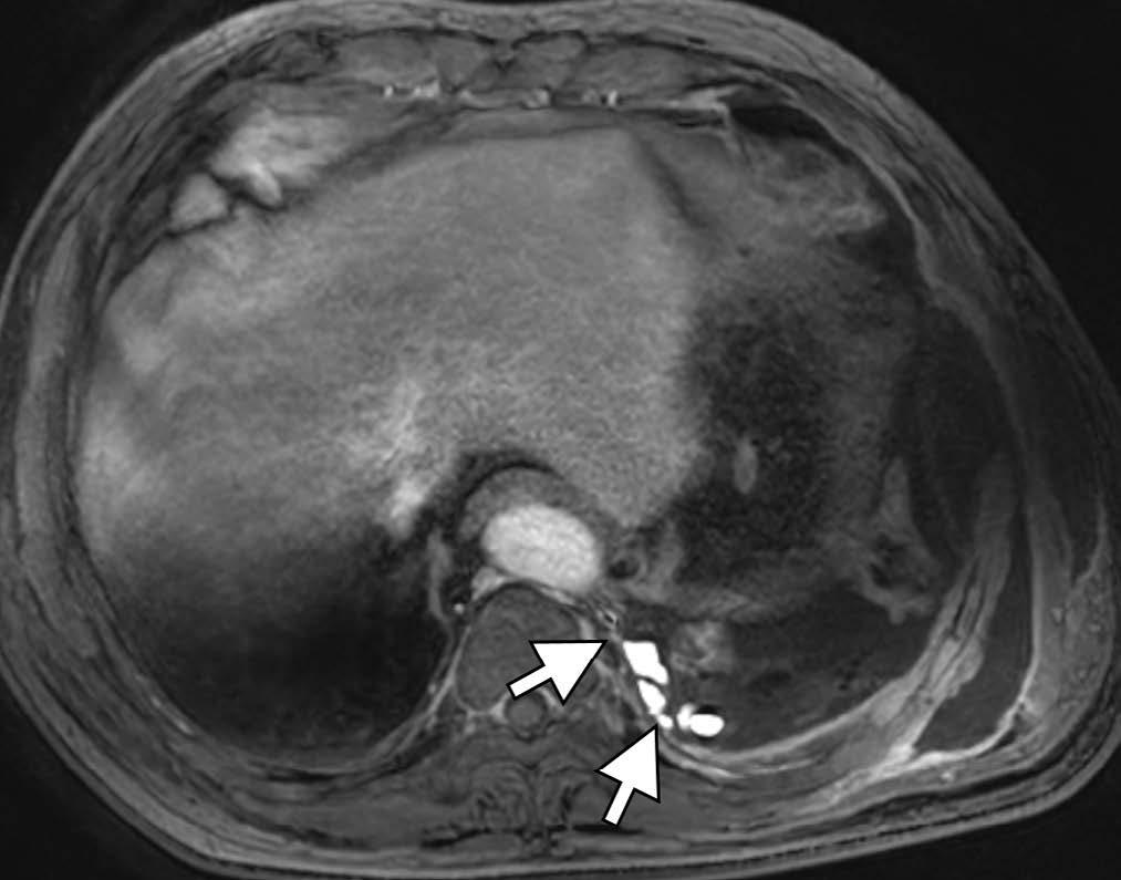 abdominal scanning after finding the leakage site. The cisterna chyli was noted on the left side of the T12 inferior endplate level (Fig. 2e).