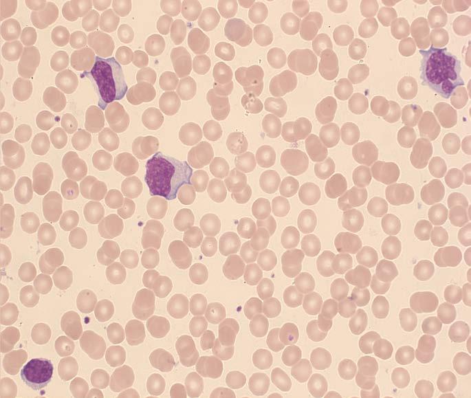 Case 2: Smear results Differential Results 60 31 3 4 1 Seg neutrophils Lymphocytes Monocytes Eosinophils Basophils Bands