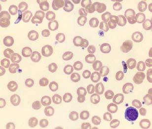 Myelocytes Promyelocytes Myeloblasts Nucleated red blood cells Comments»