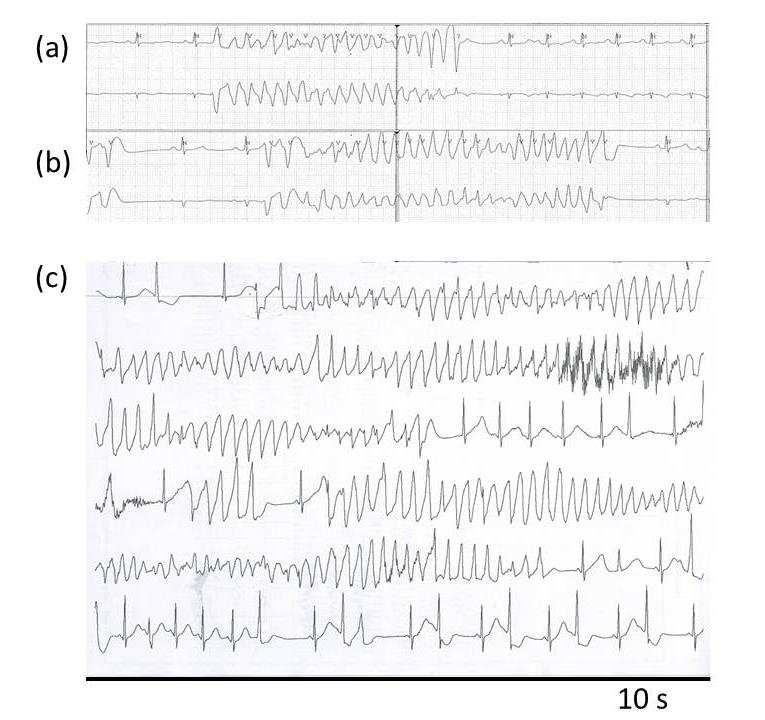 A few cases of induced fibrillation show an apparent periodic modulation of rate during the last 5-10 s of fibrillation.