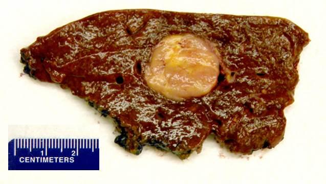 Figure 1. Gross photograph of the right hepatectomy specimen reveals a well-circumscribed gray-yellow indurated mass.
