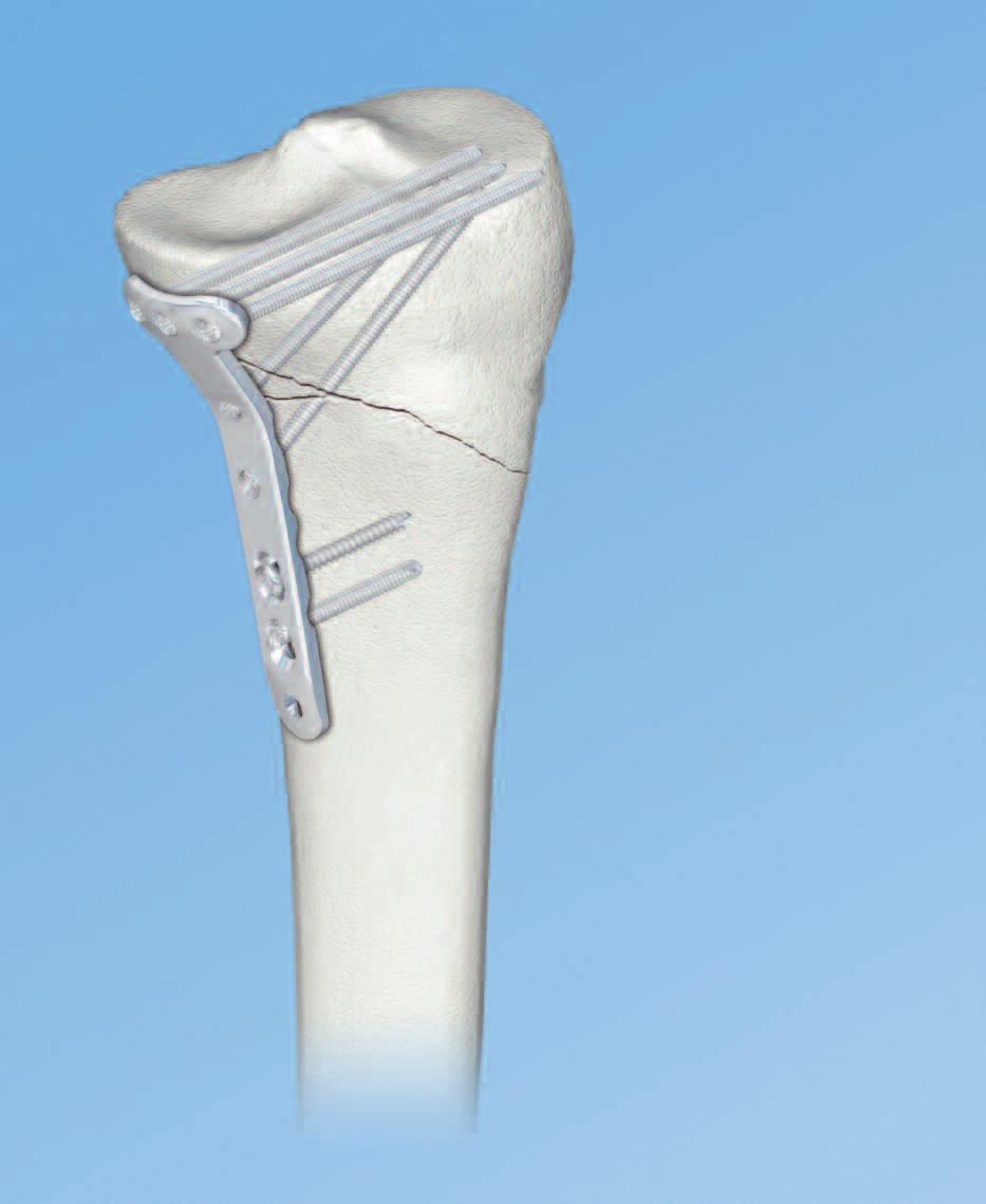 LCP Medial Proximal Tibial