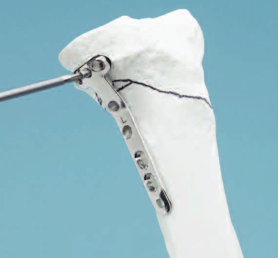 Surgical Technique Measure for screw length Measure for screw length using the depth gauge.