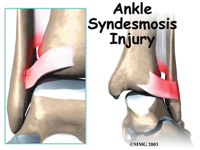 Introduction An ankle injury common to athletes is the ankle syndesmosis injury. This type of injury is sometimes called a high ankle sprain because it involves the ligaments above the ankle joint.