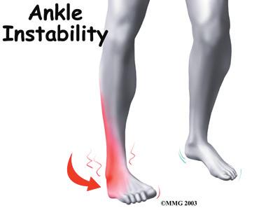 In severe tears of the ligaments, the ends of the tibia and fibula actually spread apart. This condition is called diastasis. Symptoms What does an ankle syndesmosis injury feel like?