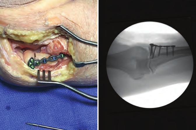 19 FINAL RADIOGRAPHS Confirm proper reduction, screw length and placement using fluoroscopy.
