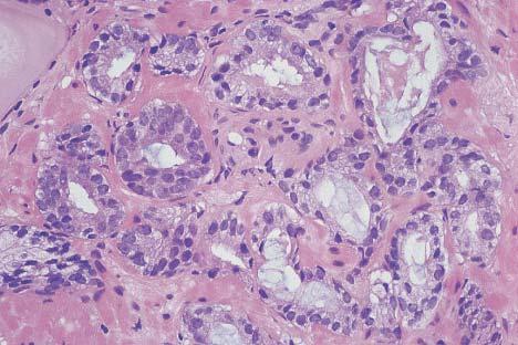 Microscopic appearance of prostatic carcinoma. Well- differentiated tumor composed of medium-sized glands.