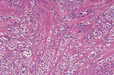 Poorly differentiated tumor growing in a diffuse fashion.