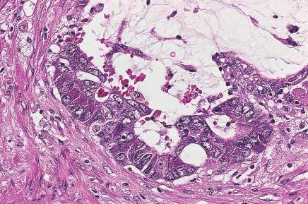 Some of the neuroendocrine cells present in this prostatic adenocarcinoma