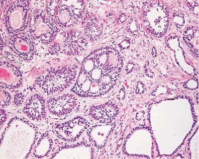 So-called adenoid basal cell tumor of prostate.