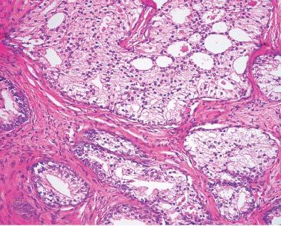Clear cell hyperplasia of prostate with a focally