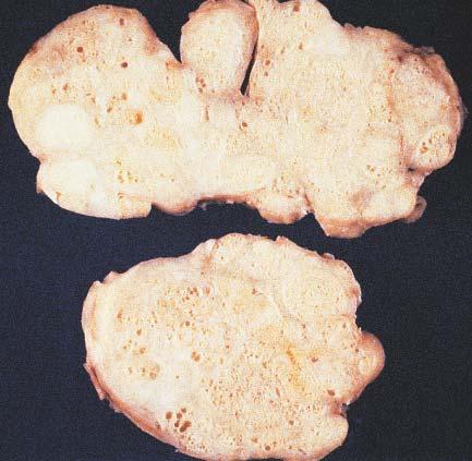 Gross appearance of nodular hyperplasia in material obtained from suprapubic