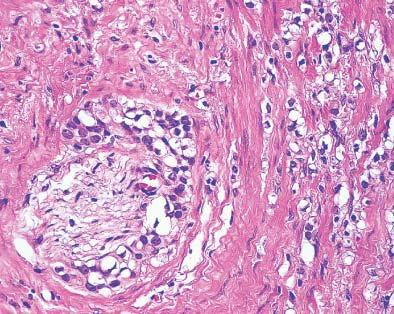 Prominent cytoplasmic vacuolation in prostatic carcinoma as a result of hormonal