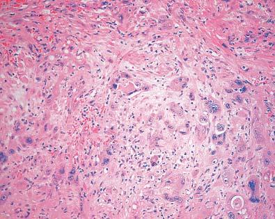 Angiosarcoma with epithelioid features involving the prostate.