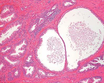 Nodular hyperplasia of prostate, with cystic dilatation of the glands.