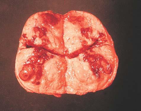 Gross appearance of infarct of prostate.
