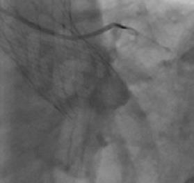 Lifetime Management Key Concerns As TAVR is applied to younger patients, new strategies