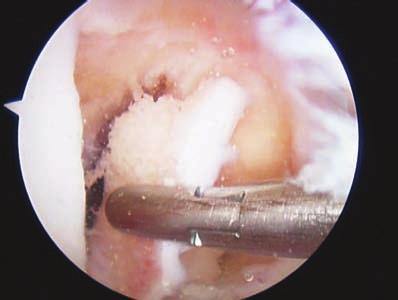 96128_CH_14 6/28/07 7:52 AM Page 177 14 Avoiding ACL Graft Impingement 177 FIGURE 14-10 Removal of lateral wallplasty