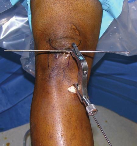96128_CH_14 6/28/07 7:52 AM Page 178 178 PART III Ligament Injuries and Instability B A FIGURE 14-13 A: Tibial guide wire drilled through lateral hole in bullet with the knee in full extension and