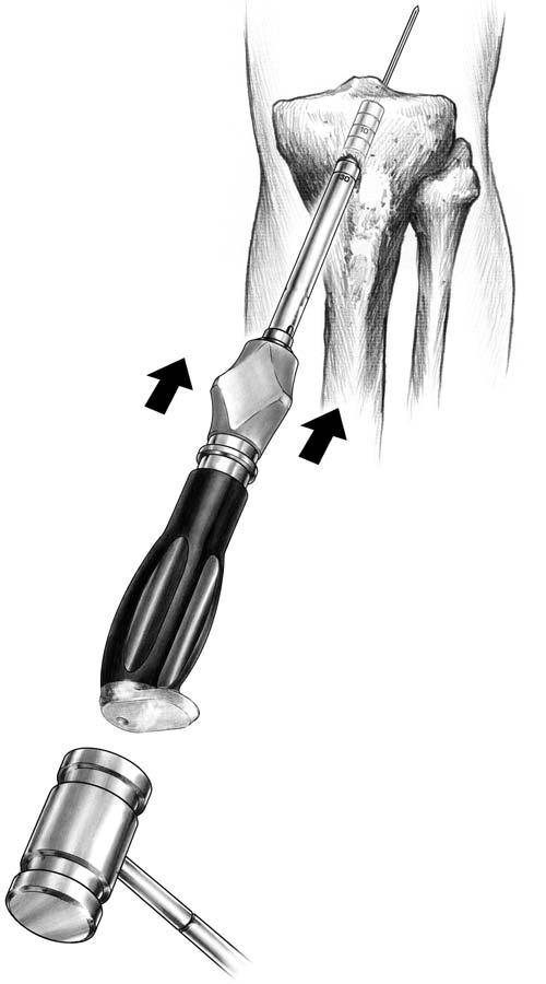 96128_CH_14 6/28/07 7:52 AM Page 179 14 Avoiding ACL Graft Impingement 179 FIGURE 14-15 Impact bone dowel harvester over guide pin.