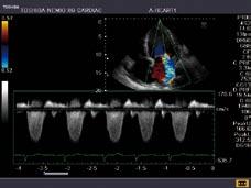ICA soft plaque: The normal Doppler spectrum confirms that