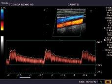 Aorta, celiac trunk, and SMA: Tissue Harmonic Imaging and