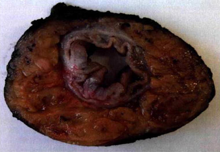 Pathohistological assessment of the circular margin of resection during total mesorectal excision, conducted on the malignant formations of the rectum Table3.