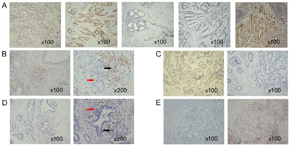 422 zho et l: B7-H4 with poor prognosis nd suppressed CD8 + T lymphocytes in humn cca Figure 1. (A) B7-H4 expression in tissue smples.
