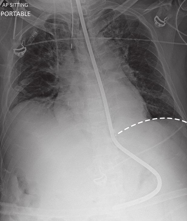 Fig. 4 Chest radiograph shows a correctly positioned Sengstaken-Blakemore tube prior to the inflation of the gastric balloon and the expected level of the gastroesophageal junction (*).