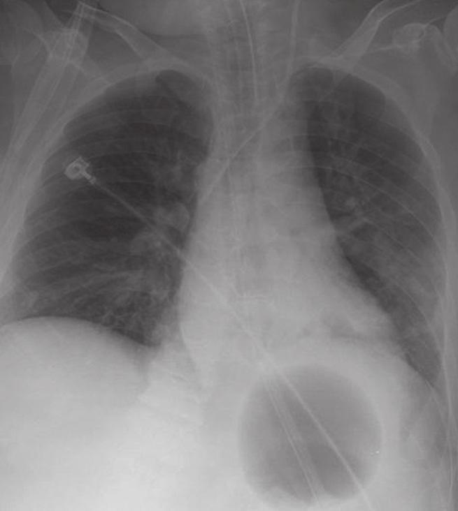 AP: anteroposterior ABSTRACT Oesophageal rupture is a life-threatening complication of balloon tamponade for bleeding oesophageal varices.