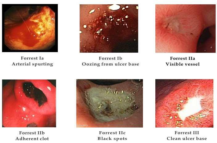 Management of Acute Gastric Ulcer Bleeding 289 described an endoscopic classification system that is commonly used (Figure 2).