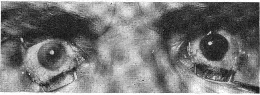 studied by many authors. von Hippel (1901) considered that glaucoma was due to obstruction of the chamber angle with pigment (Hanssen, 1923).