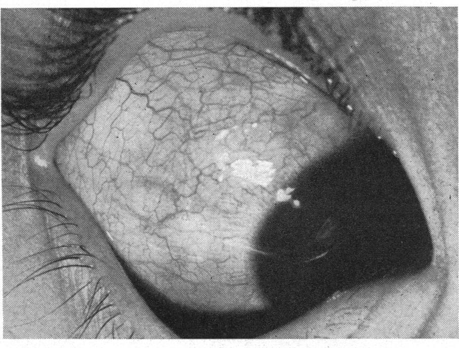 -Apart from diffuse pigmentation of the sclera in the lower portions, there was a definite Krukenberg spindle on the posterior surface of the cornea with small dots.