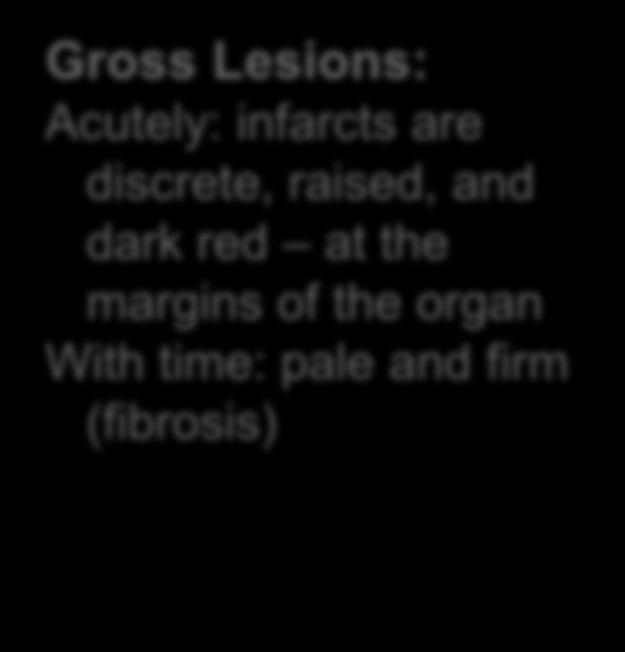 (mitral or aortic) to thrombosis Gross