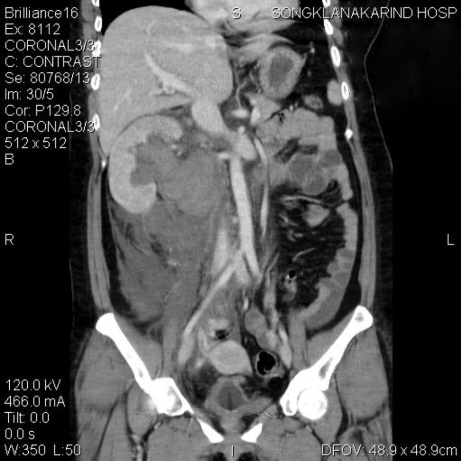 Renal Infarction: Report of a Case Presenting with Spontaneous Retroperitoneal Hematoma 1A
