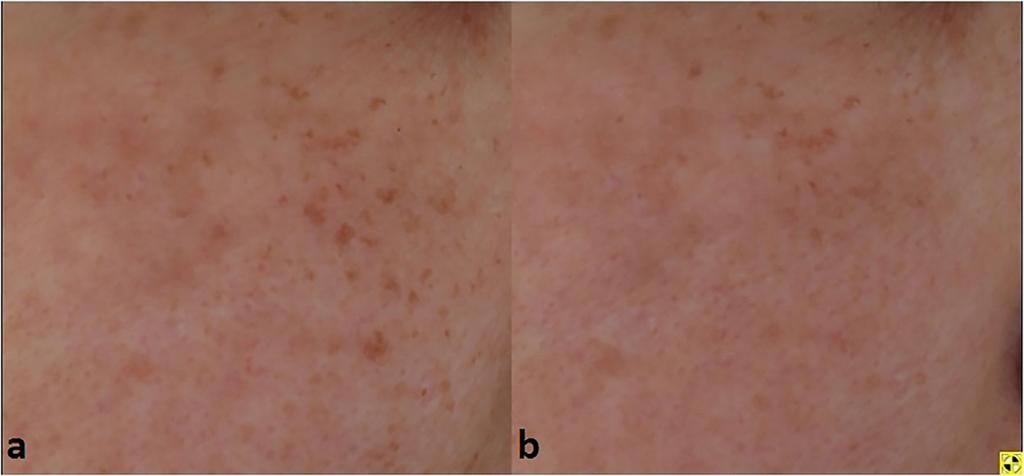 FRACTIONATED PICOSECOND LASER WITH DLA FOR CHINESE SKIN 11 Fig. 1. Ephelides. (a) Baseline, (b) 3 month after sixth treatment (755 nm, 0.