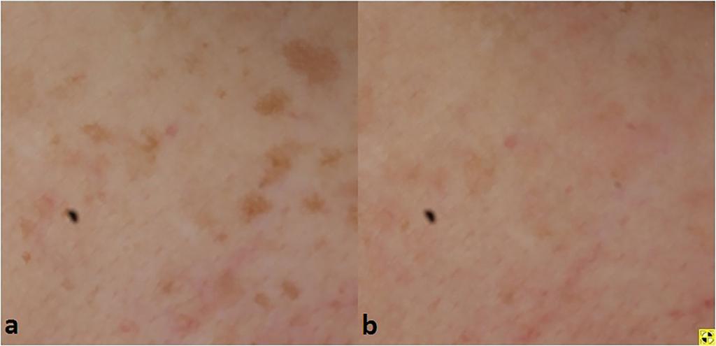 [7] Interestingly, an increasing amount of evidence suggests that picosecond laser has an important role to play in the treatment of skin of color due to the potentially increased