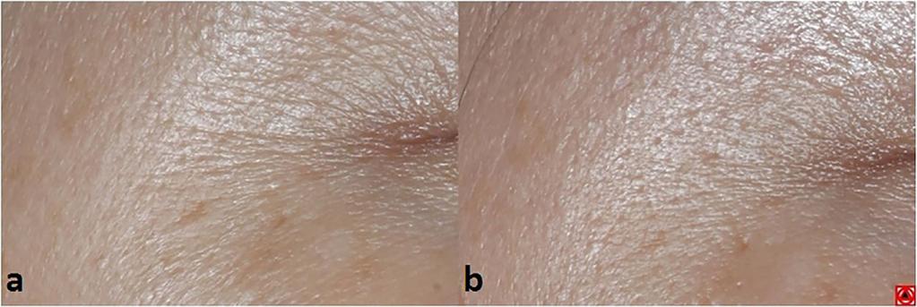 epidermal junction (DEJ), which resolve into vacuolated structures known as laser induced optical breakdown (LIOB).
