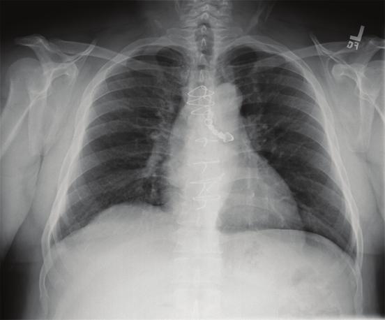 2 Case Reports in Medicine Figure 1: Chest radiograph shows a dental prosthesis lodged in the left mainstem bronchus. 3.