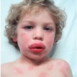 Urticaria (hives) Angioedema -swelling of face, eyes,lips Wheezing Vomiting