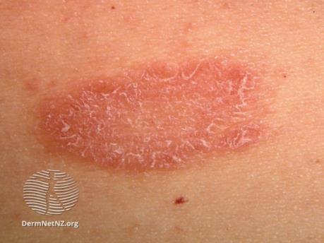 Pityriasis rosea - Viral rash, lasts about 6-12 weeks - Due to reactivation of herpes 6/7 (roseola infantum in